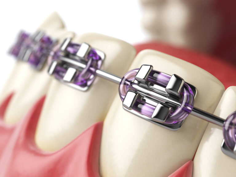 Where can I get Traditional Braces Encino?