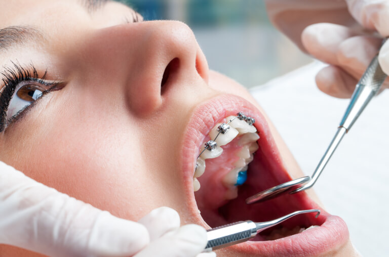 Dental decay with braces: how to prevent it